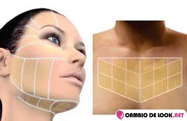 ultherapy estiramiento facial no invasivo